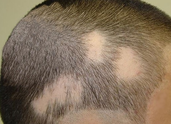Alopecia-areata--crop